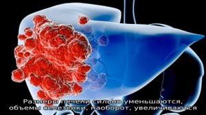 Четыре стадии цирроза печени