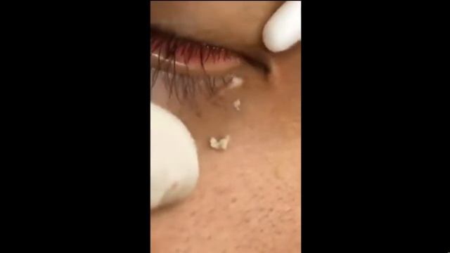 # 6 ШОООК Большой жировик в прямо в глазу!!!\КАМЕДОН\Большой жировик