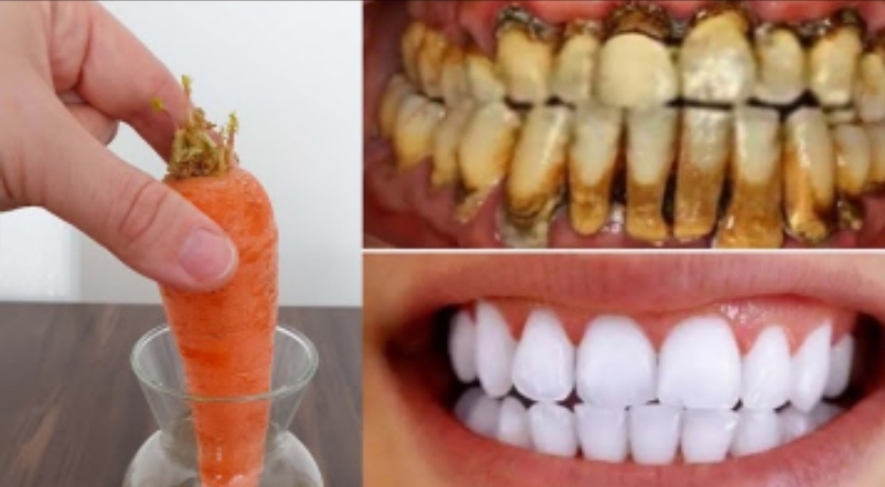 Отбеливание зубов всего за 2 минуты- сделайте пожелтевшие и отложенные зубные камни молочно- белыми смотреть онлайн