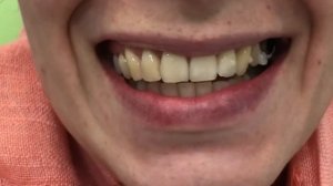 Элайнеры — прозрачные капы; как снимать/одевать