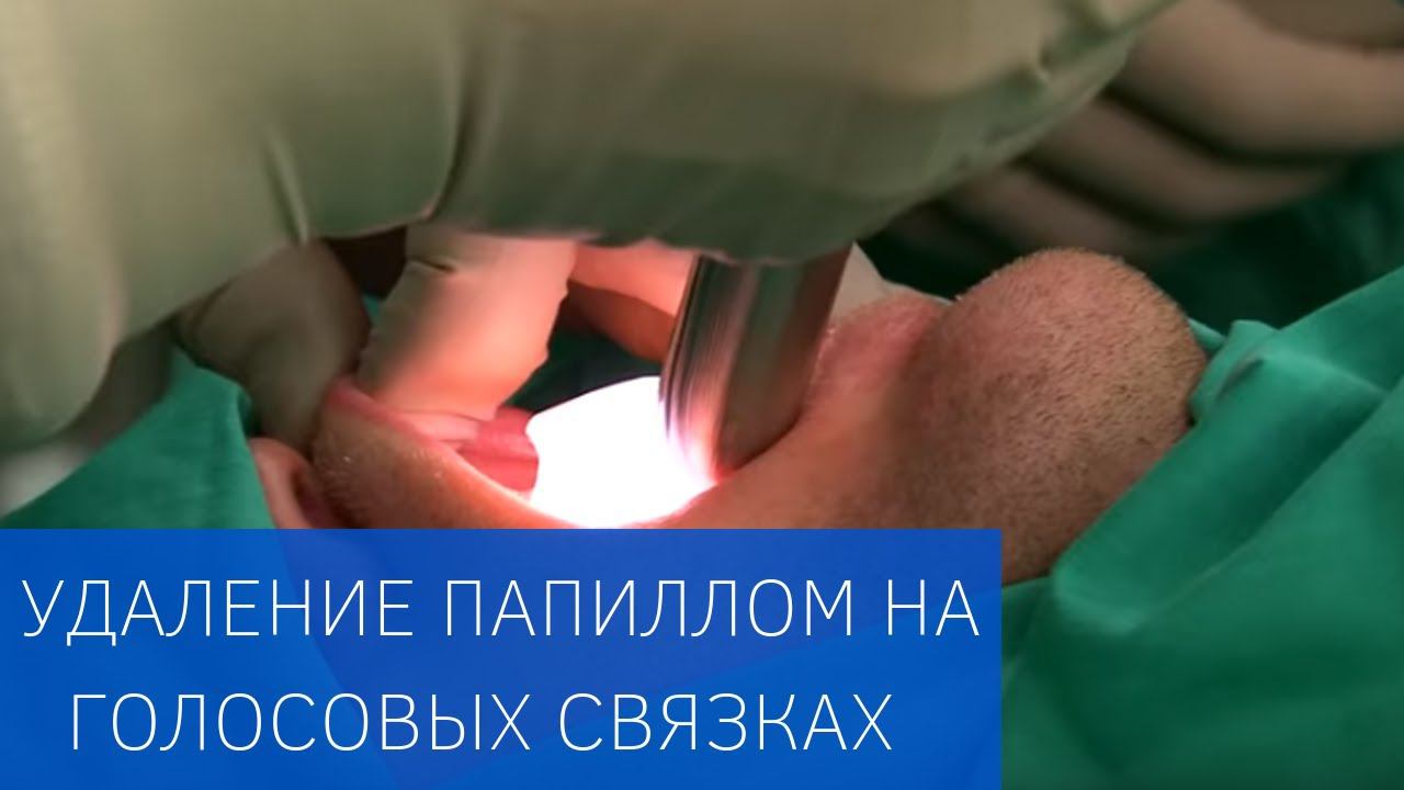 Удаление папиллом в области голосовых складок в ЕМС смотреть онлайн