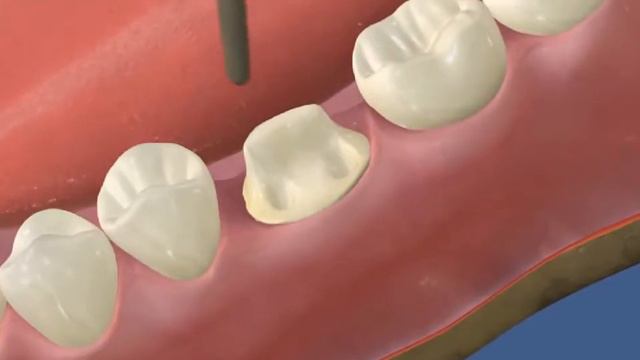Установка культевой вкладки и коронки смотреть онлайн