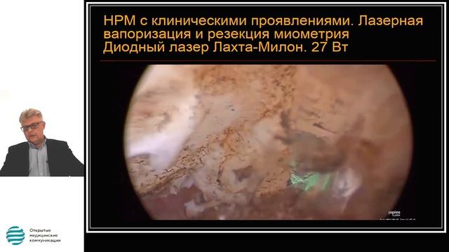 Несостоятельность рубца на матке после кесарева сечения. Критерии диагноза. смотреть онлайн