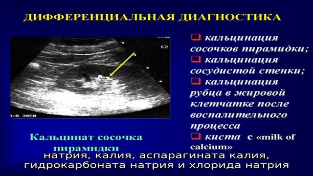 Микрокальцинаты в почках смотреть онлайн