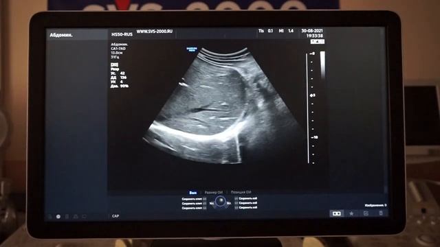 Samsung Medison HS50 обзор ультразвукового сканера смотреть онлайн