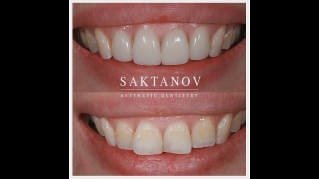 Виниры - цена в Алматы | Выпирают передние два зуба | Разбор кейса за 400000 тенге
