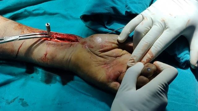 Volar Locking Plate Distal Radius (Modified Henry's Approach) смотреть онлайн