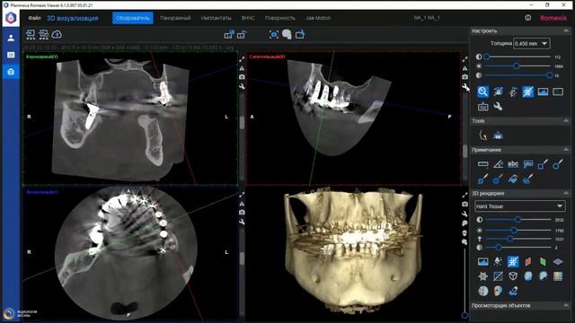 Методы визуализации нормы и патологии на КЛКТ. Разбор клинических случаев. смотреть онлайн