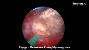 Мини-перкутанная нефролитотрипсия
