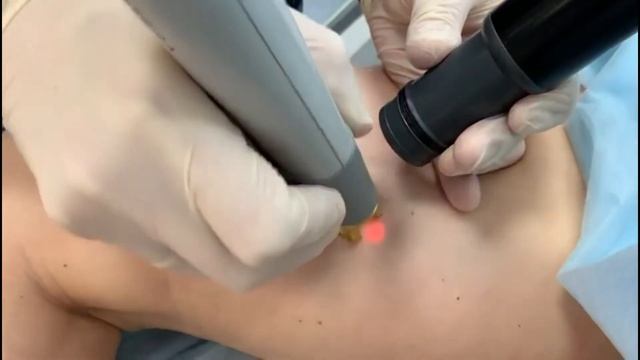 Лазерное удаление сосудистых звездочек на ногах в Петербурге