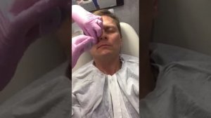 Контурная пластика носослезной борозды препаратом Teosyal RHA 3