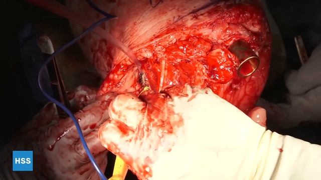 Osseointegration of the Tibia After Primary Amputation - Live Surgery смотреть онлайн