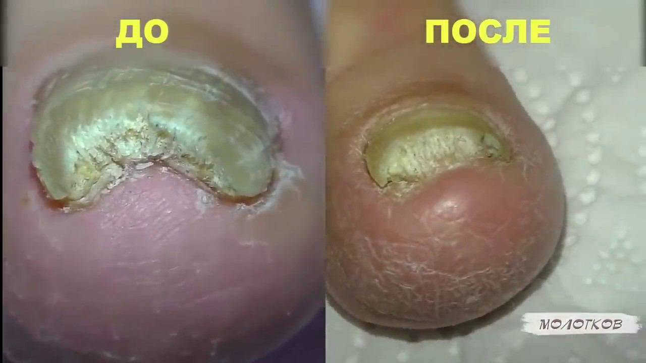 Отзывы о лечении грибка перекисью смотреть онлайн