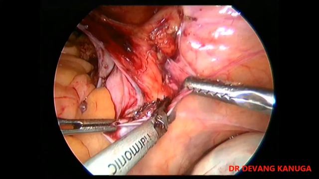 lymph node dissection iliac and obturator смотреть онлайн