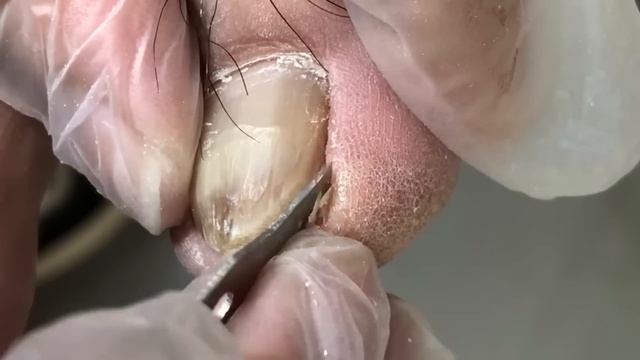 Toenails Hide Huge Ingrown Nails, Dig It Out【Crazy Pedicure Room】