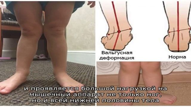 Массаж при вальгусе стоп у ребенка смотреть онлайн
