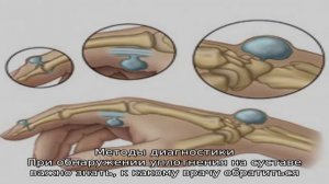 Что такое гигрома