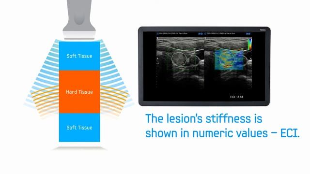 E Thyroid (ECI) - методика эластографии щитовидной железы Samsung Medison (обзор) смотреть онлайн