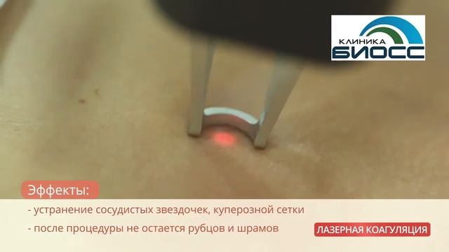 Удаление сосудистых звездочек. Лазерная коагуляция сосудов.