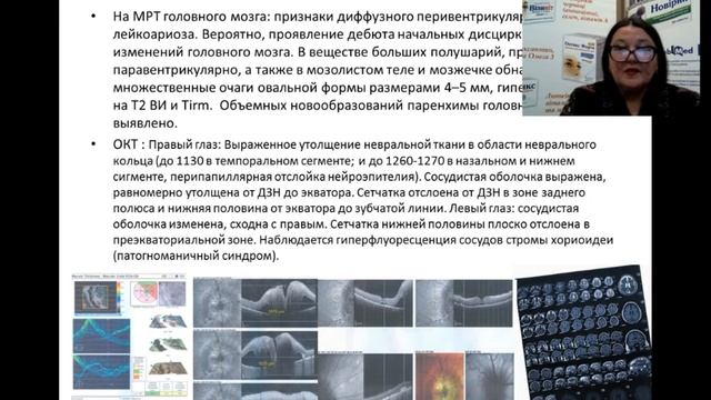 Синдром Фогта - Каянаги - Харада. Случай из практики - Коновалова Н.В. смотреть онлайн