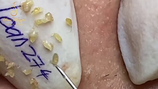 Interesting With Blackheads And Whiteheads (274_ep1)