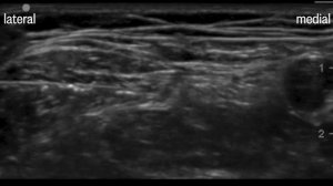 Блокада латерального кожного нерва бедра (Femoral and lateral femoral cutaneous nerve blocks)