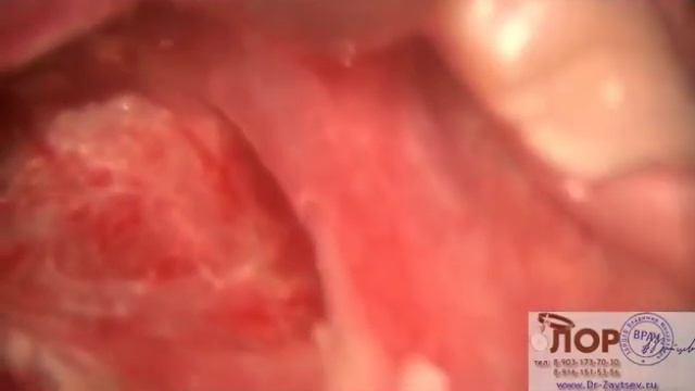 Холодноплазменная тонзиллэктомия