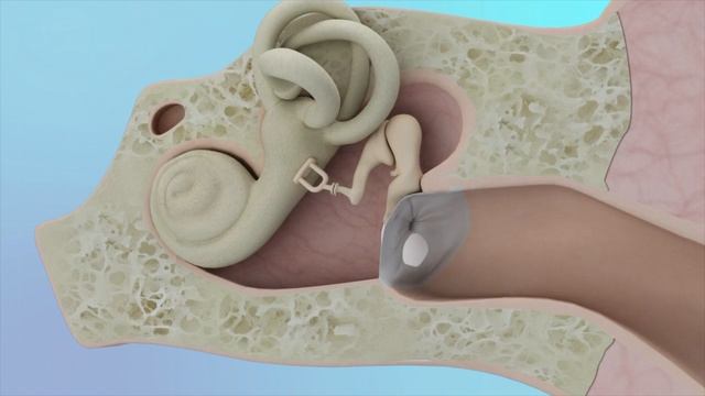 Eardrum Hole Repair Animation смотреть онлайн