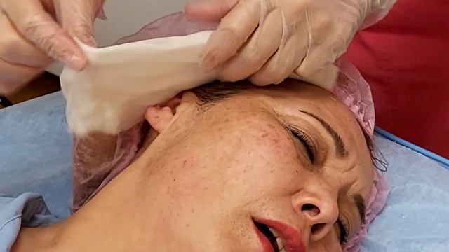 Мезонити для лифтинга в области щек. смотреть онлайн