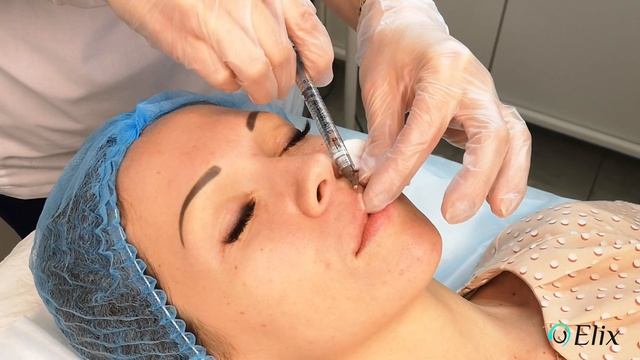 Коррекция и увеличение губ (Juvederm Ultra 3, 1 мл), Клиника лазерной косметологии ELIX, Новосибирс смотреть онлайн