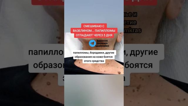 смешиваю с ВАЗЕЛИНОМ ПАПИЛЛОМЫ ОТПАДАЮТ ЧЕРЕЗ 3 ДНЯ #народнаямедицина #долголетие #здоровье #зож смотреть онлайн