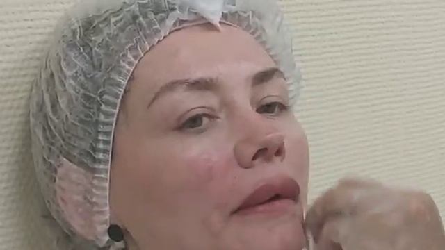 АирисКом студенты учатся: коррекция носогубных складок филлером средней плотности.