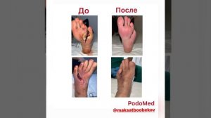 Гангрена. Незаживающие раны. Диабетическая стопа. Ампутация