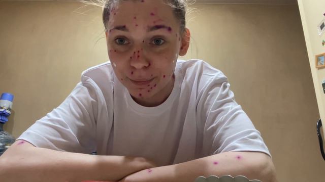Как лечить ветрянку у взрослых #ветрянка #взрослыйсветрянкой смотреть онлайн