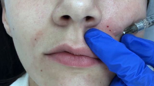 Коррекция носогубных складок ГК смотреть онлайн