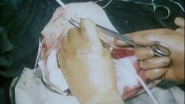 Активное хирургическое лечение гнойных ран смотреть онлайн