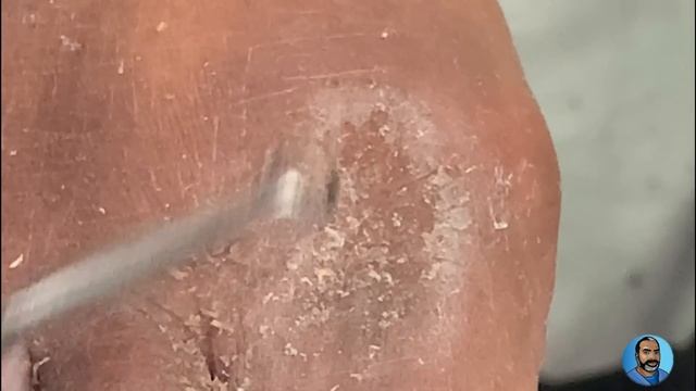 That's Toe Jam! The Build-up Between Toes Explained, Trimming Of Fungal Toenails, and Skin Scales смотреть онлайн