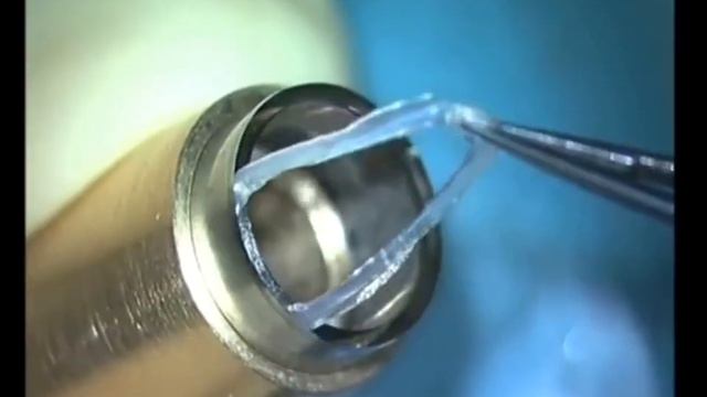 ❗Новое в лечении кератоконуса - CAIRS (роговичные сегменты из донорской роговицы) смотреть онлайн