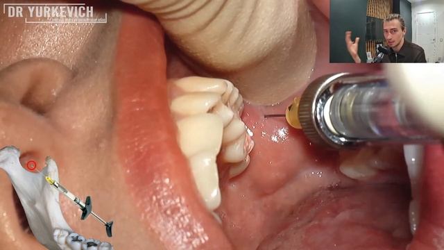 Как сделать проводниковую анестезию на нижней челюсти | Разбор техники обезболивания нижних зубов смотреть онлайн