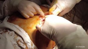 Боковая вентральная грыжа. Сложный пациент.