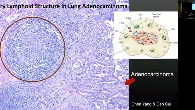 Tertiary Lymphoid Structures in Cancer смотреть онлайн