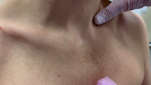 Тонкости лимфатического массажа при панических атаках . смотреть онлайн