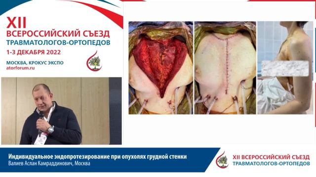 Индивидуальное эндопротезирование при опухолях грудной стенки. Валиев Аслан Камраддинович смотреть онлайн