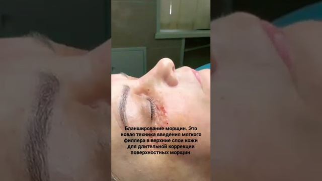 Бланширование морщин смотреть онлайн