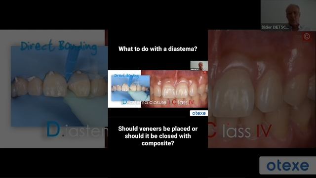 A fragment of webinar by Dr. Didier Dietschi “Bioesthetic rehabilitation with direct restorations” смотреть онлайн