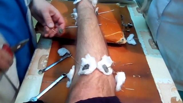Боль,вся беспощадность снятия апарата смотреть онлайн