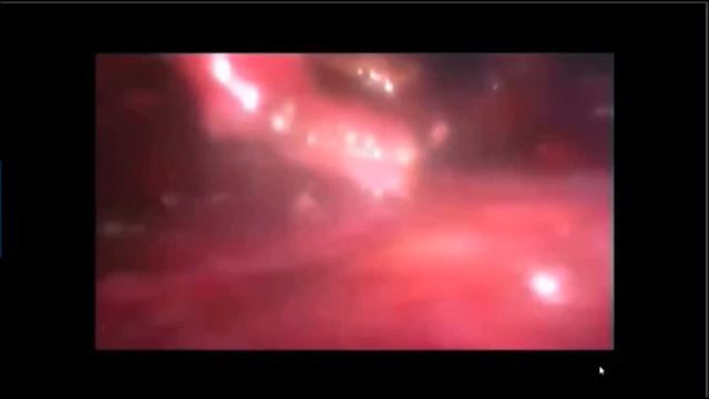 Симпатэктомия: эндоскопическая поясничная и грудная симпатэктомия смотреть онлайн