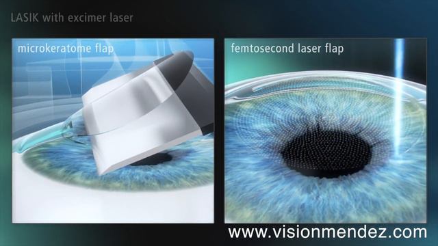 LASIK vs FEMTO-LASIK смотреть онлайн