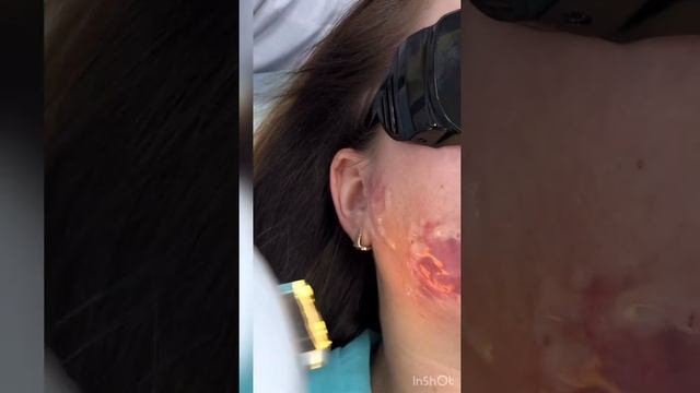 Винные пятна IPL