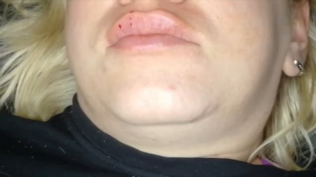 Увеличение губ аугментация филлером гиалуроновой кислотой Get Lip Injections For The First Time смотреть онлайн